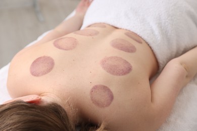 Photo of Woman after cupping therapy in spa salon, closeup