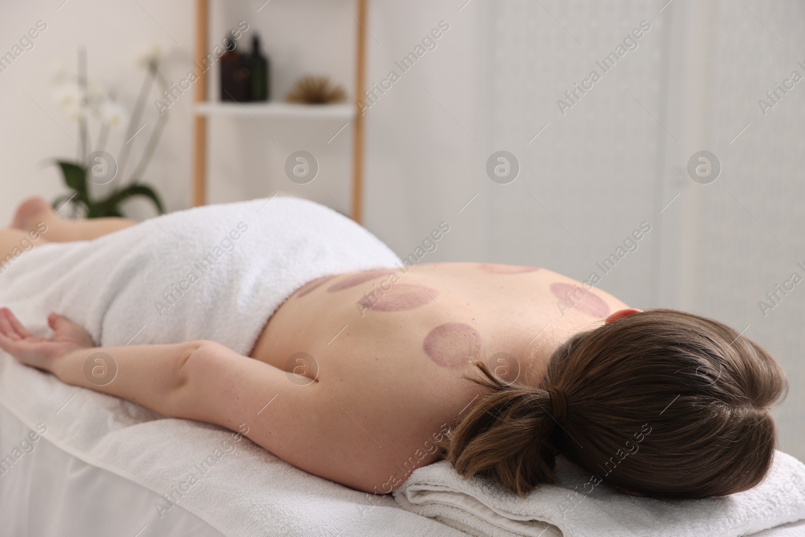 Woman after cupping therapy in spa salon Photo of Woman after cupping therapy in spa salon