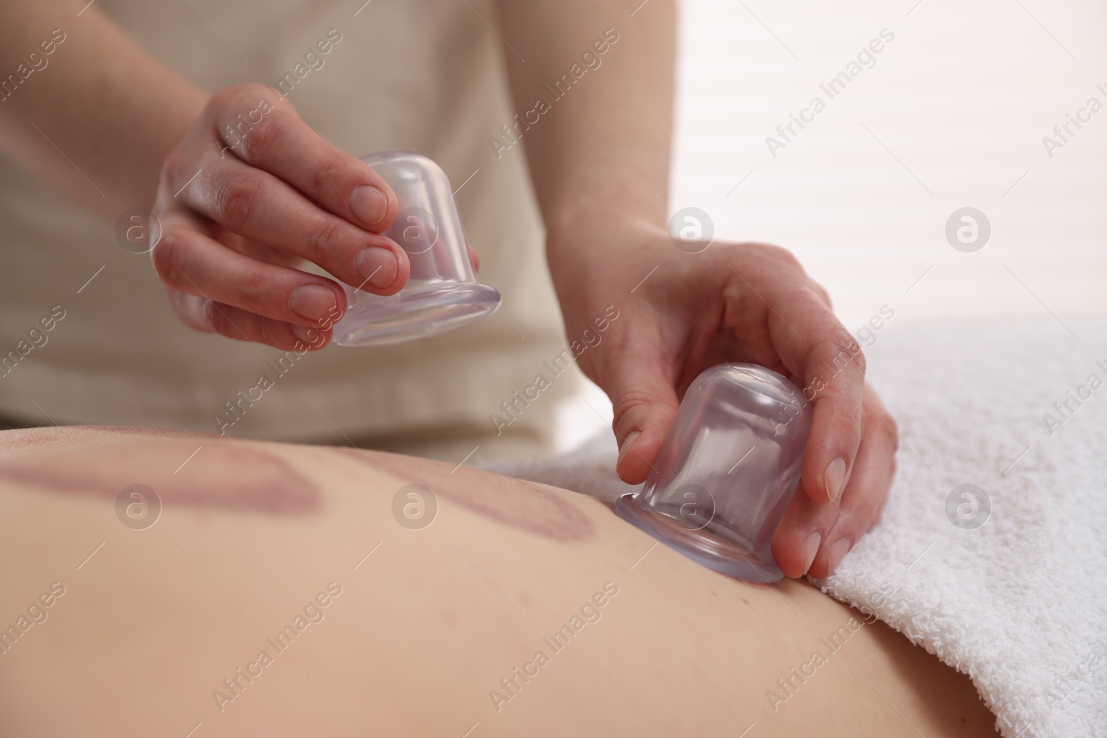 Therapist giving cupping treatment to patient in spa salon, closeup Photo of Therapist giving cupping treatment to patient in spa salon, closeup