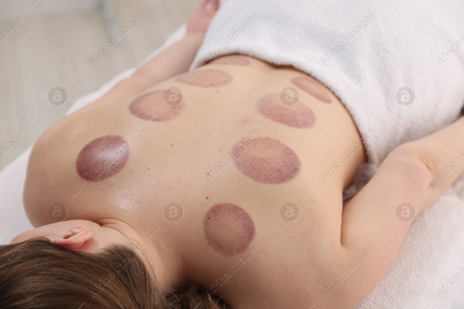 Woman after cupping therapy in spa salon, closeup Photo of Woman after cupping therapy in spa salon, closeup