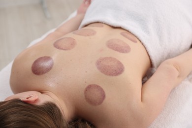 Photo of Woman after cupping therapy in spa salon, closeup