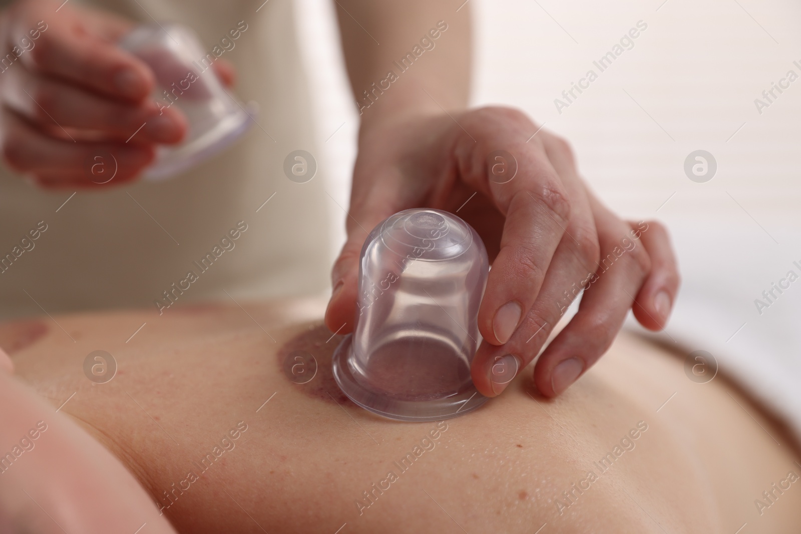 Therapist giving cupping treatment to patient in spa salon, closeup Photo of Therapist giving cupping treatment to patient in spa salon, closeup