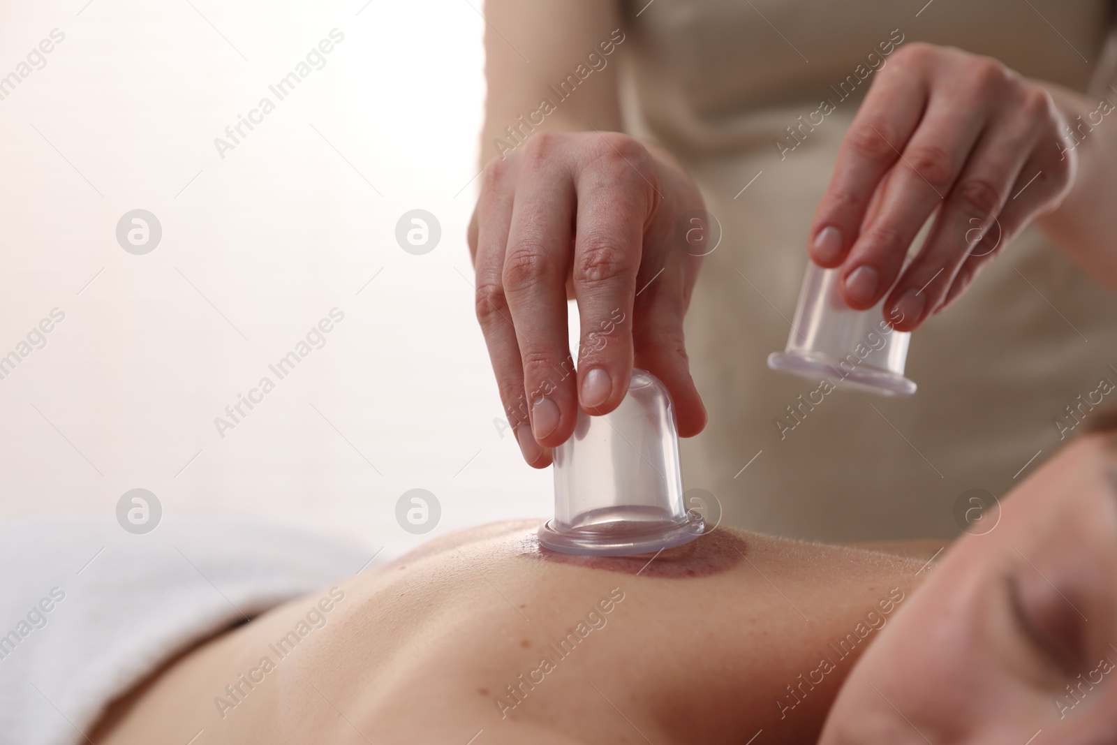 Therapist giving cupping treatment to patient in spa salon, closeup Photo of Therapist giving cupping treatment to patient in spa salon, closeup