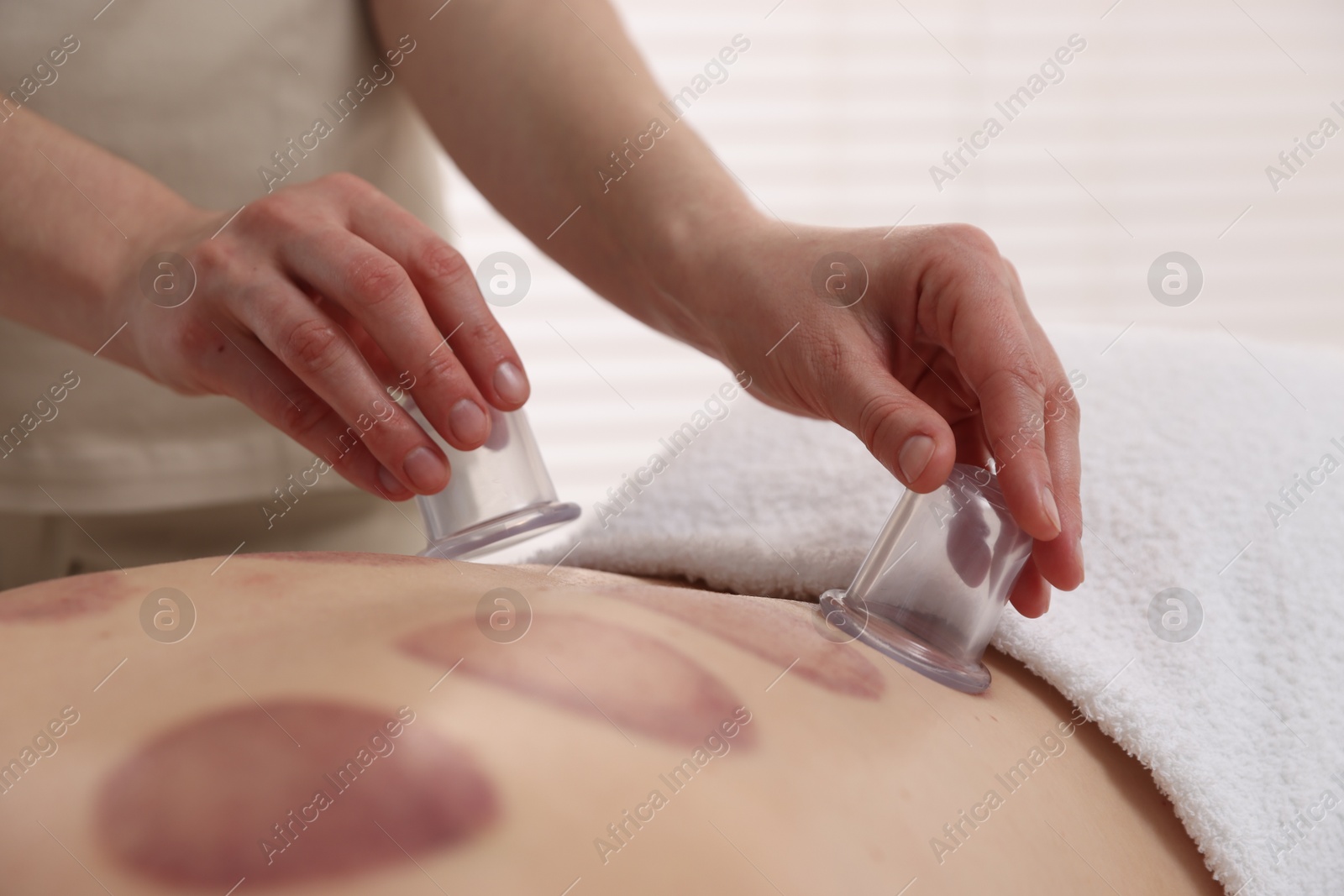 Therapist giving cupping treatment to patient in spa salon, closeup Photo of Therapist giving cupping treatment to patient in spa salon, closeup