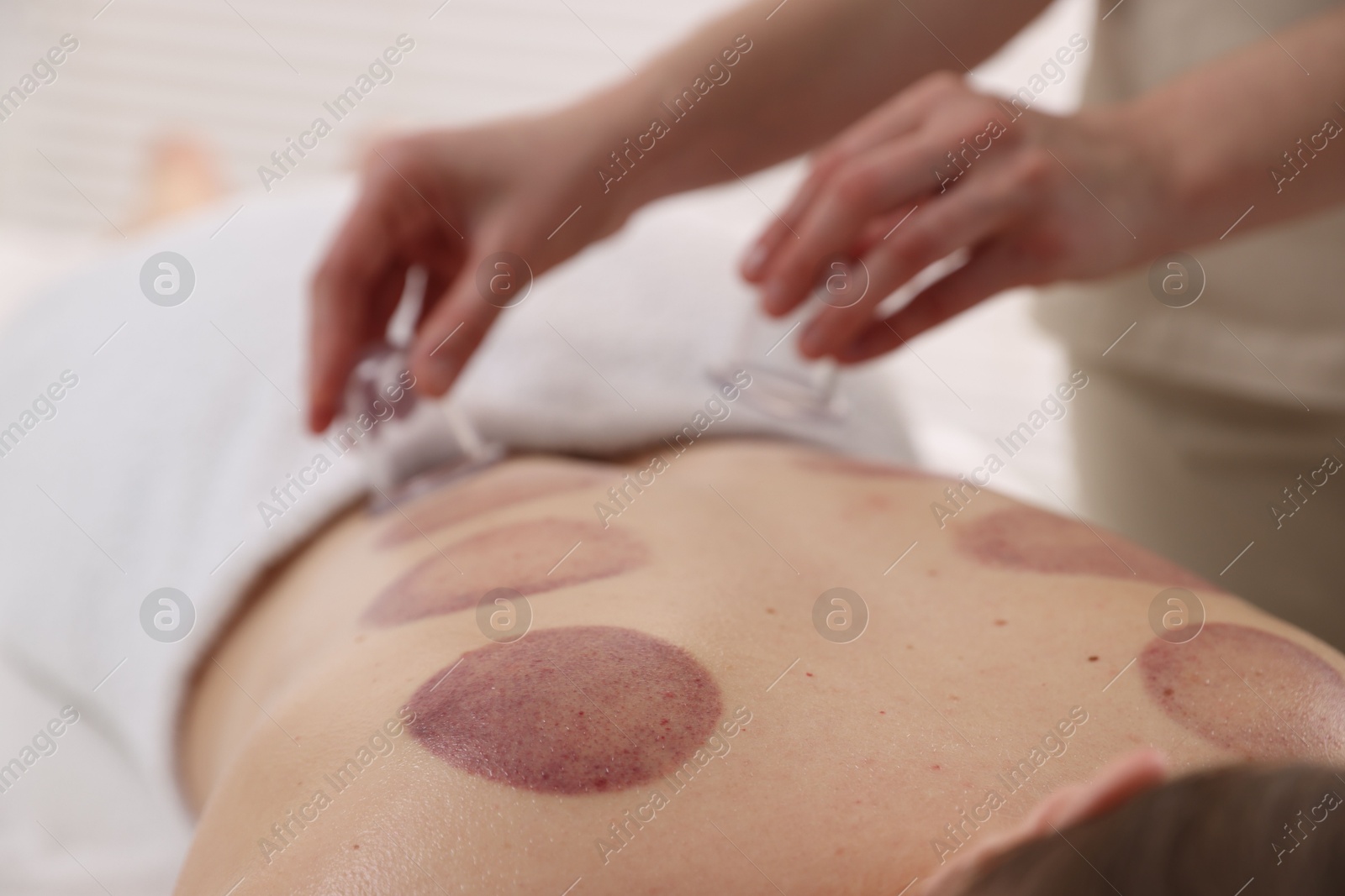 Therapist giving cupping treatment to patient in spa salon, closeup Photo of Therapist giving cupping treatment to patient in spa salon, closeup