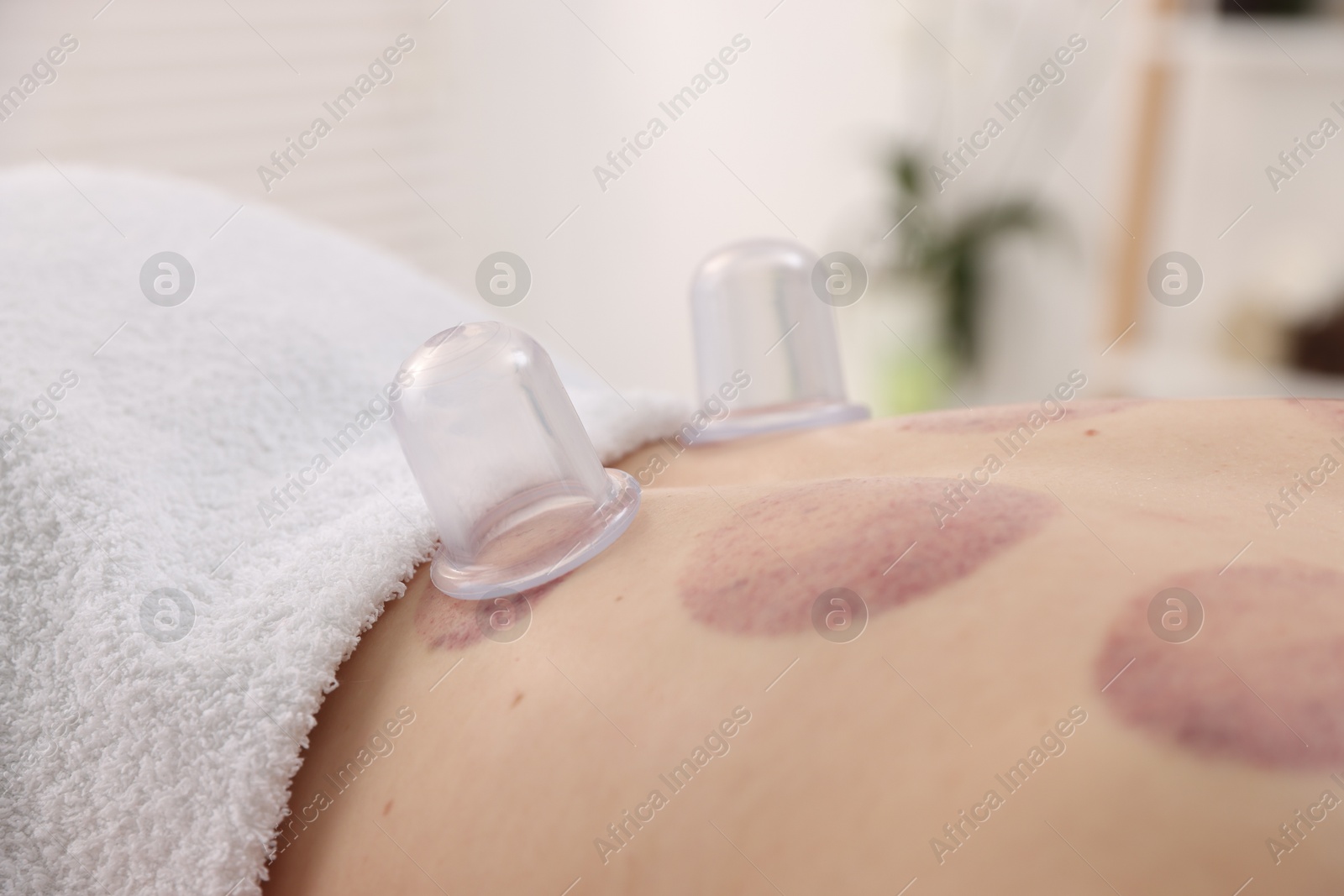 Cupping therapy. Woman with cups in spa salon, closeup Photo of Cupping therapy. Woman with cups in spa salon, closeup