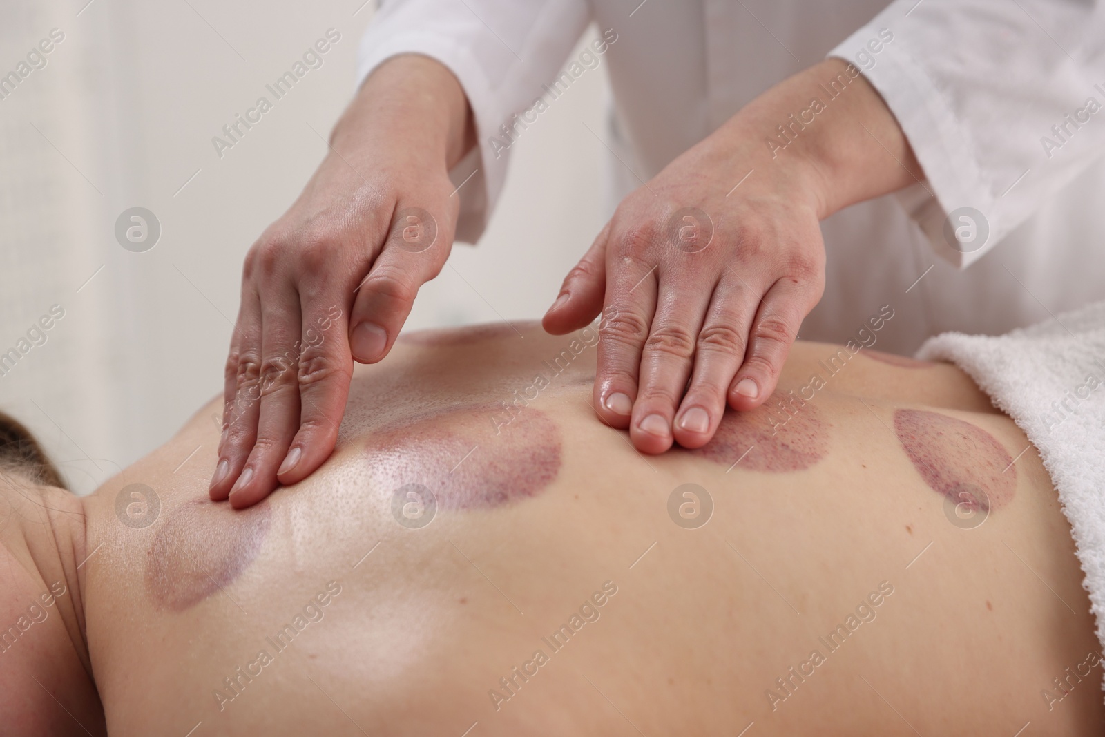 Cupping therapy. Woman receiving professional massage in spa salon, closeup Photo of Cupping therapy. Woman receiving professional massage in spa salon, closeup
