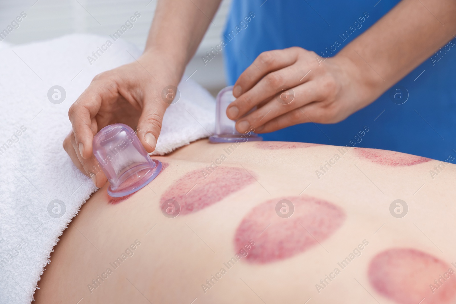 Therapist giving cupping treatment to patient in spa salon, closeup Photo of Therapist giving cupping treatment to patient in spa salon, closeup