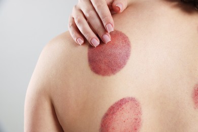 Photo of Woman after cupping therapy on gray background, closeup