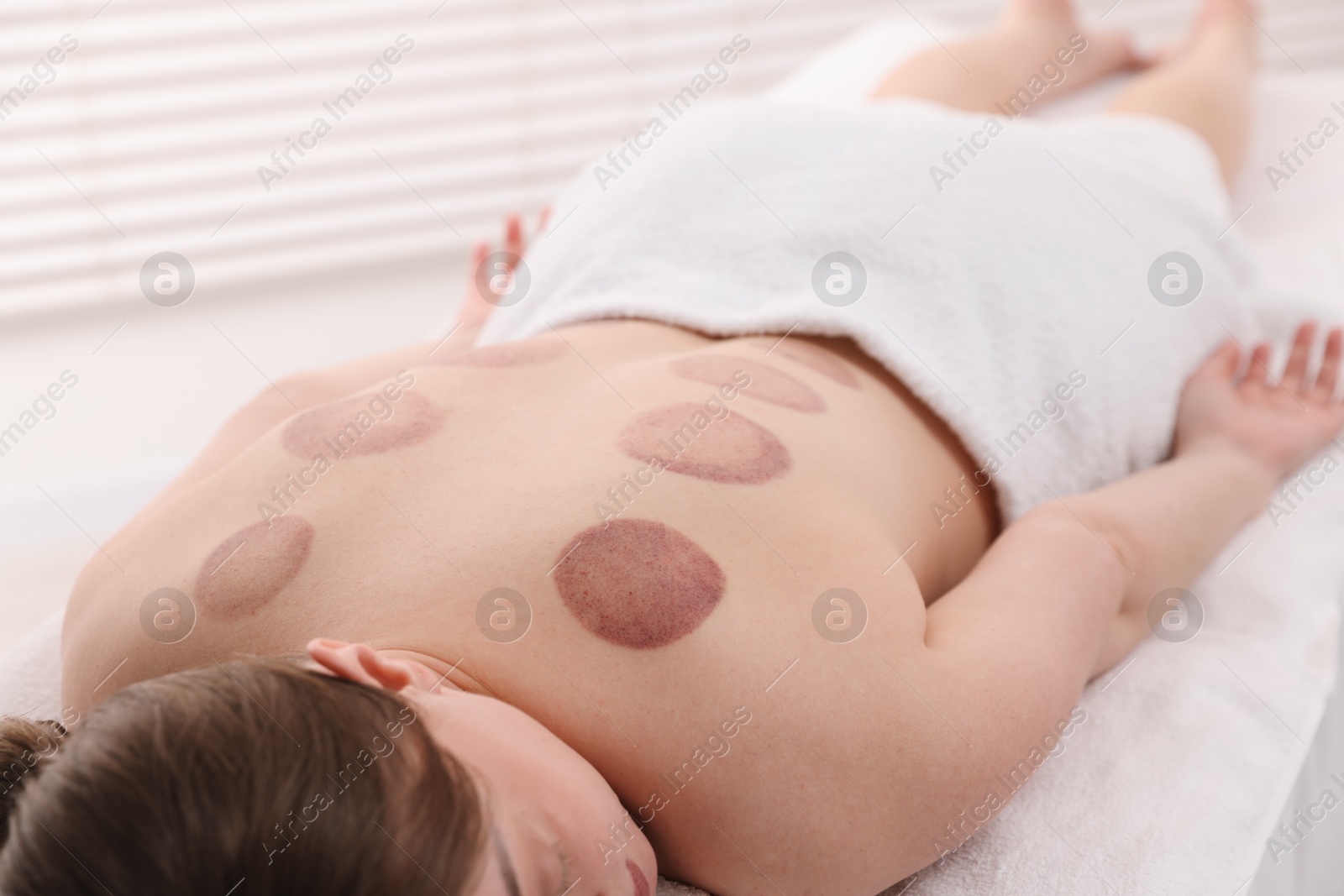 Woman after cupping therapy in spa salon, closeup Photo of Woman after cupping therapy in spa salon, closeup