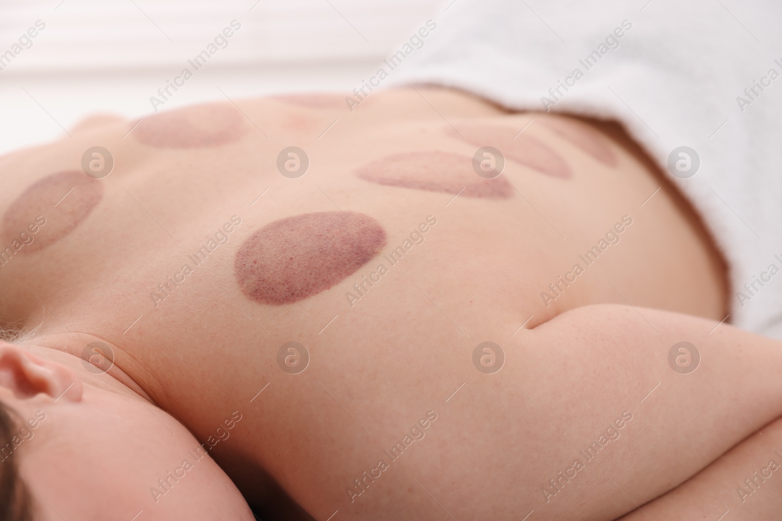 Photo of Woman after cupping therapy in spa salon, closeup