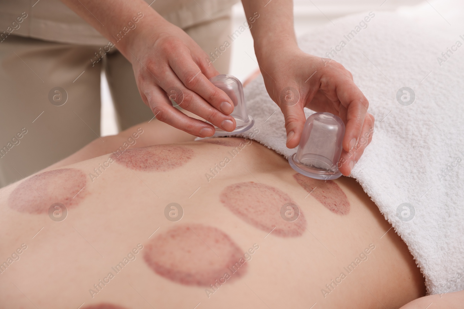 Therapist giving cupping treatment to patient in spa salon, closeup Photo of Therapist giving cupping treatment to patient in spa salon, closeup