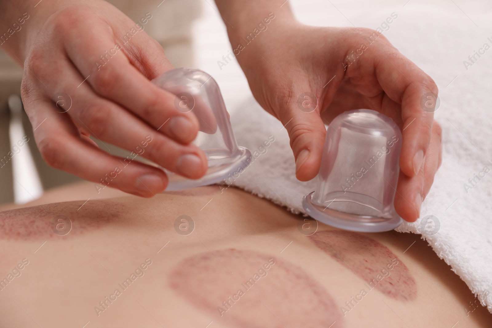 Therapist giving cupping treatment to patient in spa salon, closeup Photo of Therapist giving cupping treatment to patient in spa salon, closeup