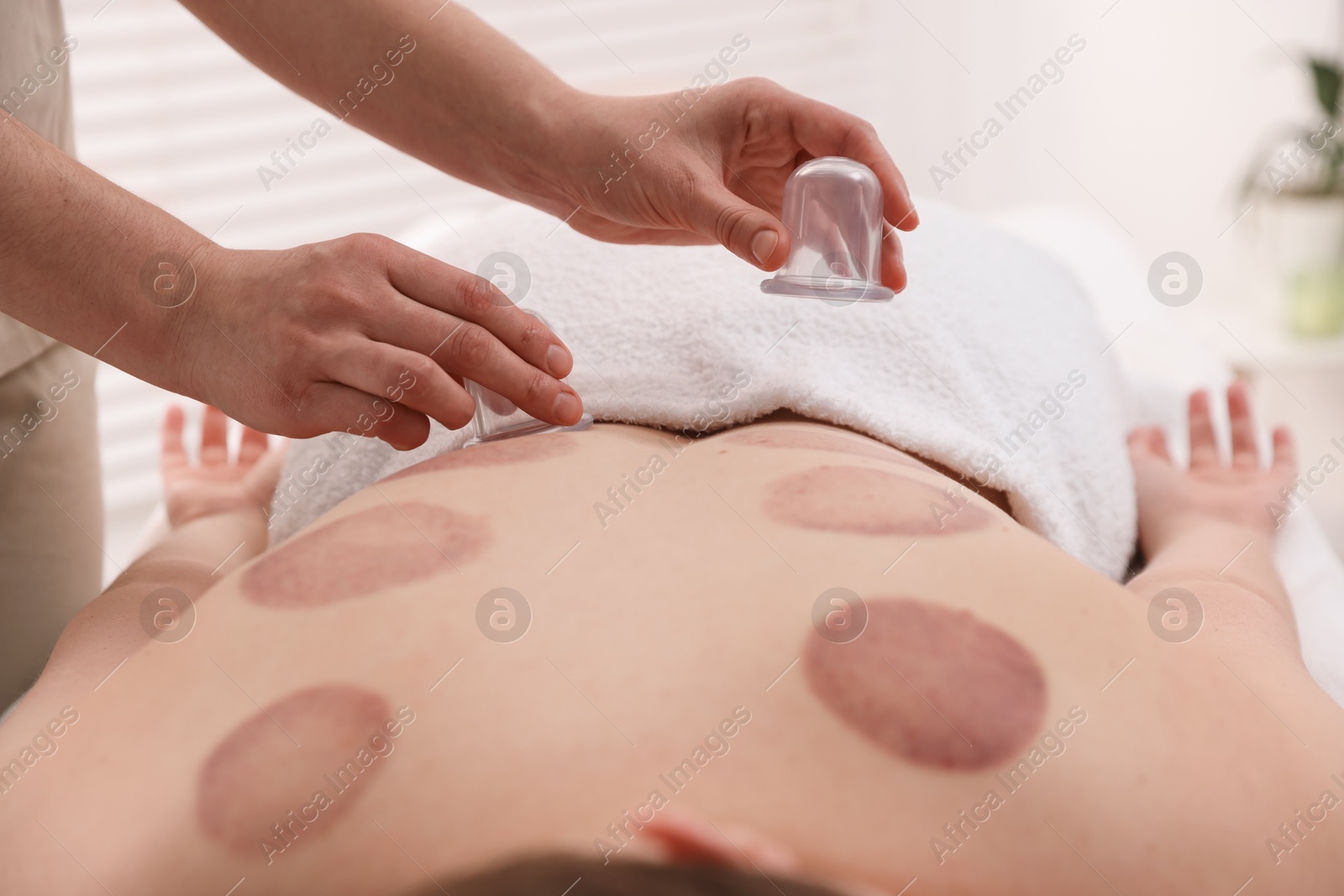 Photo of Therapist giving cupping treatment to patient in spa salon, closeup