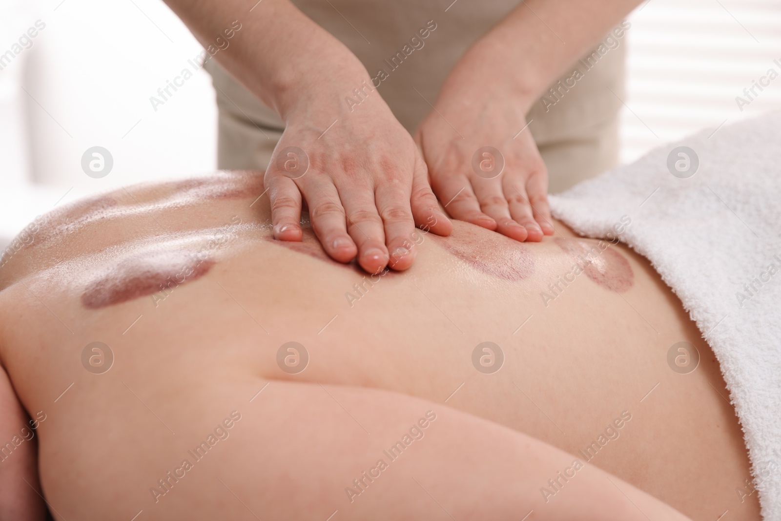 Cupping therapy. Woman receiving professional massage in spa salon, closeup Photo of Cupping therapy. Woman receiving professional massage in spa salon, closeup