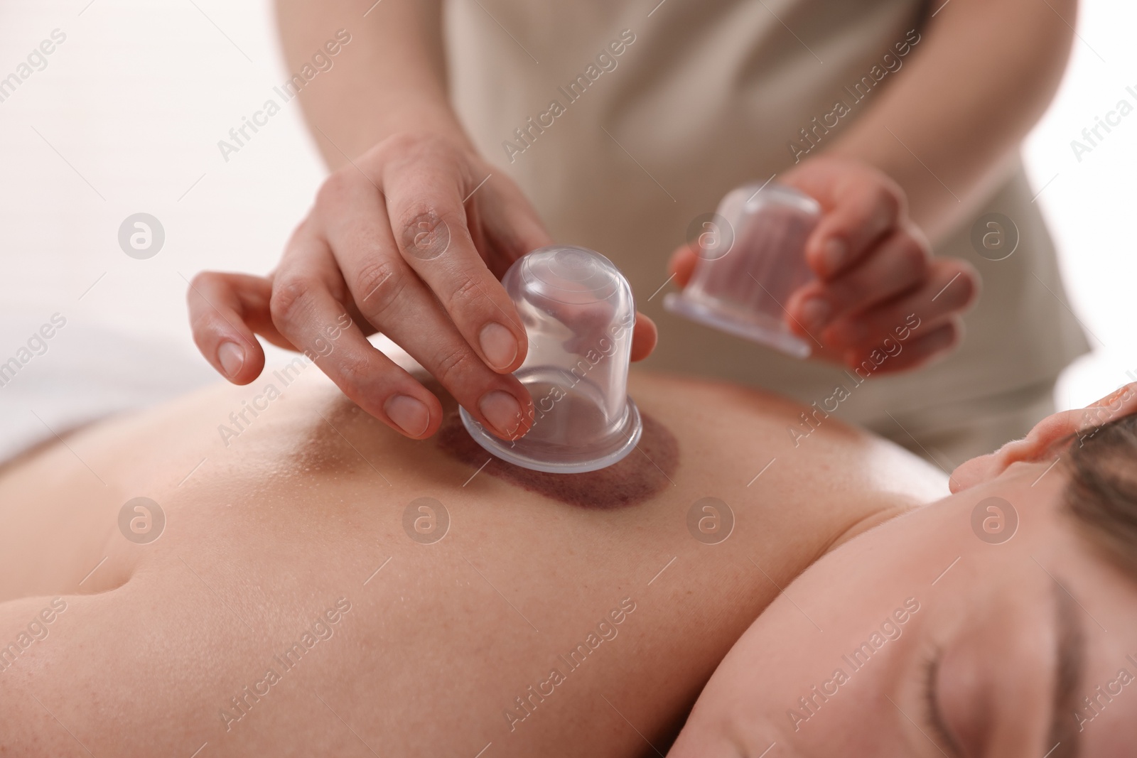 Photo of Therapist giving cupping treatment to patient in spa salon, closeup