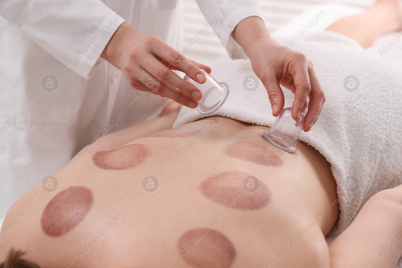 Photo of Therapist giving cupping treatment to patient in spa salon, closeup