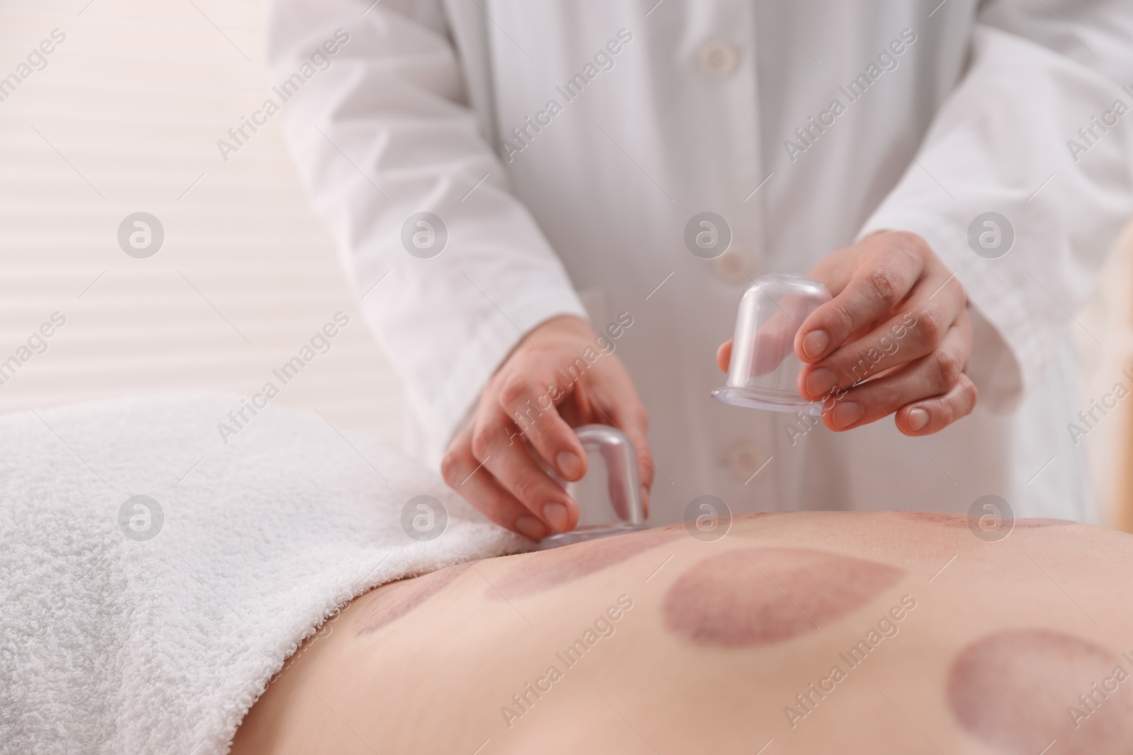 Therapist giving cupping treatment to patient in spa salon, closeup Photo of Therapist giving cupping treatment to patient in spa salon, closeup