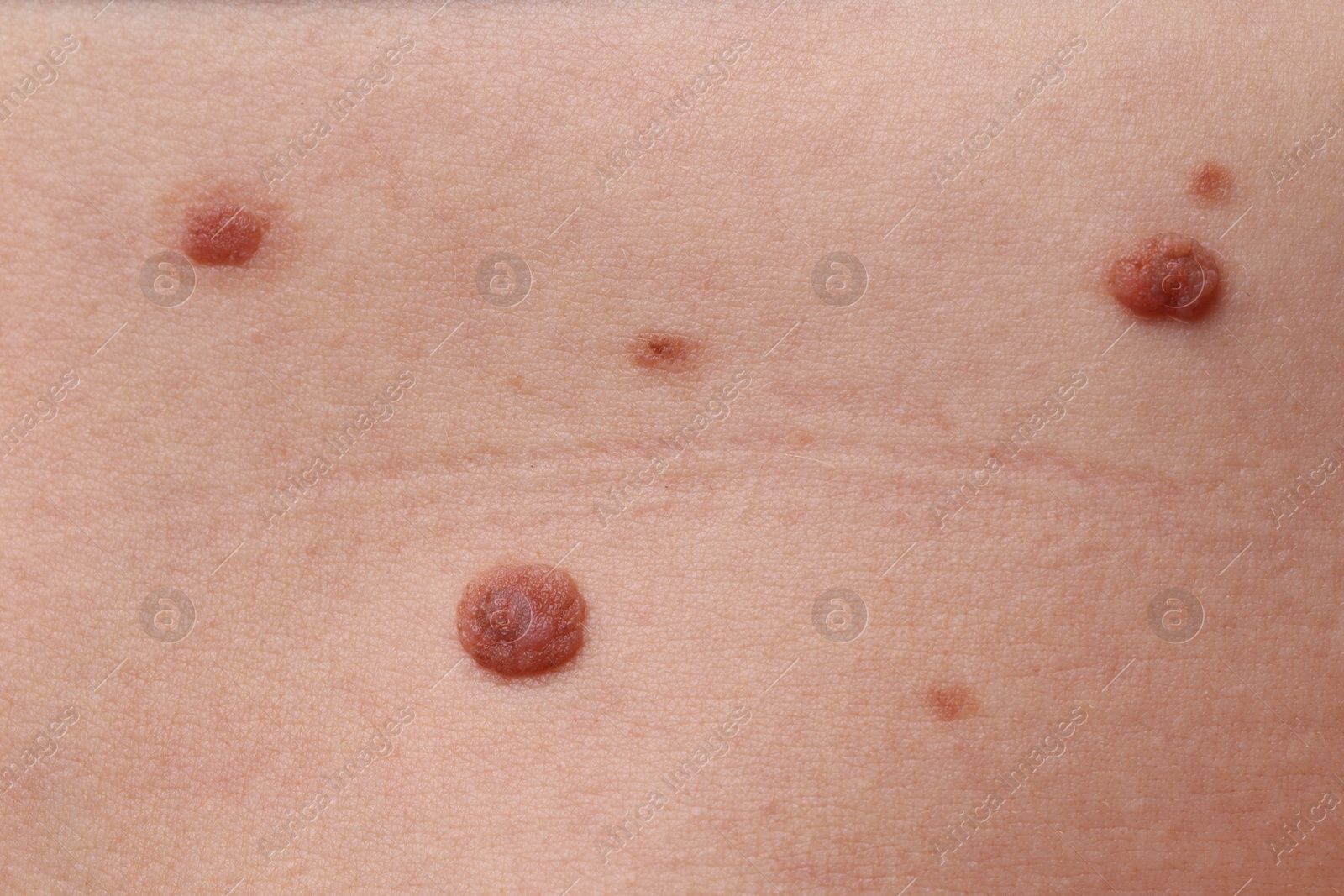 Photo of Woman with moles on her body, closeup