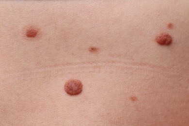 Photo of Woman with moles on her body, closeup