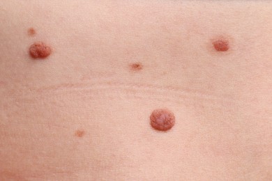 Photo of Woman with moles on her body, closeup