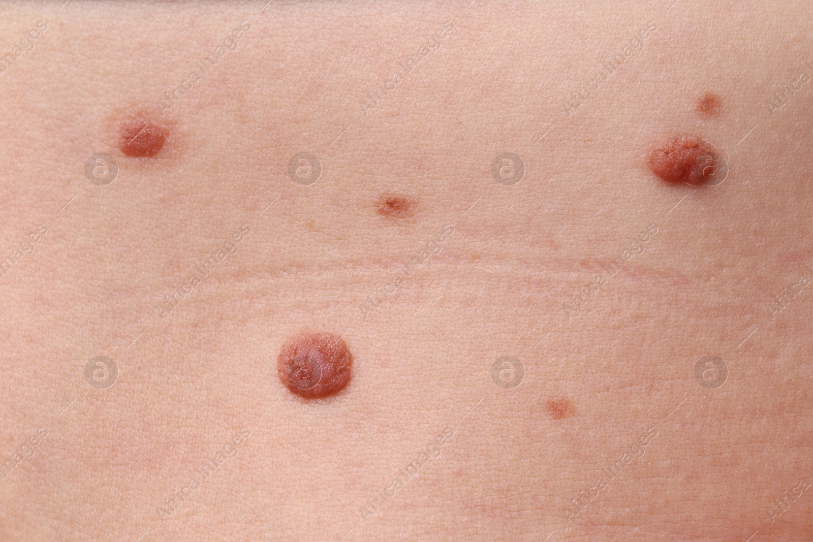 Photo of Woman with moles on her body, closeup