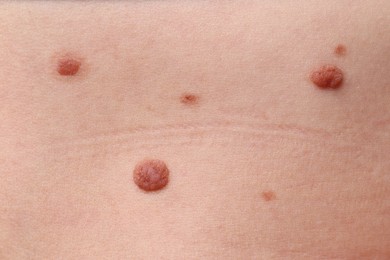 Photo of Woman with moles on her body, closeup