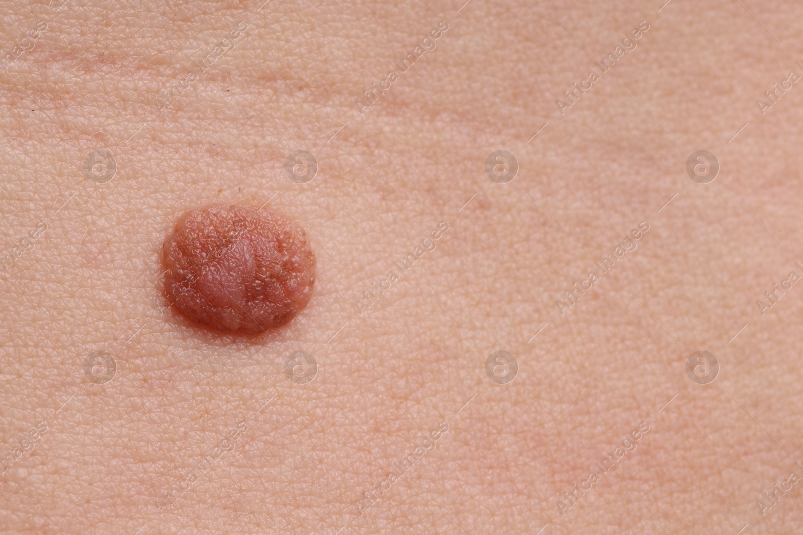 Woman with mole on her body, closeup Photo of Woman with mole on her body, closeup