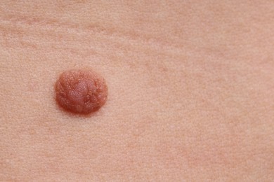 Photo of Woman with mole on her body, closeup