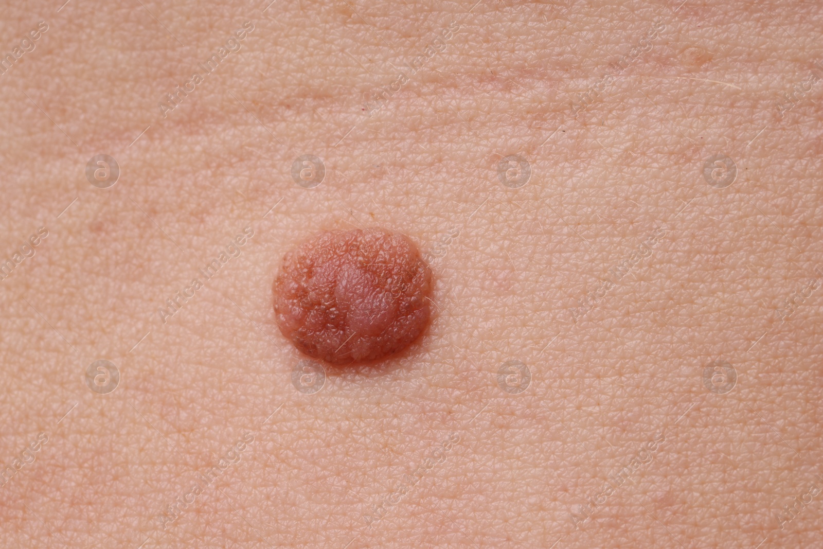 Photo of Woman with mole on her body, closeup