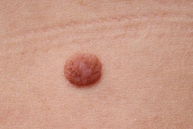 Photo of Woman with mole on her body, closeup