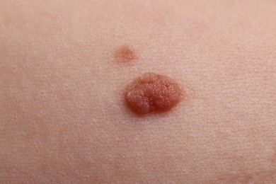 Photo of Woman with moles on her body, closeup