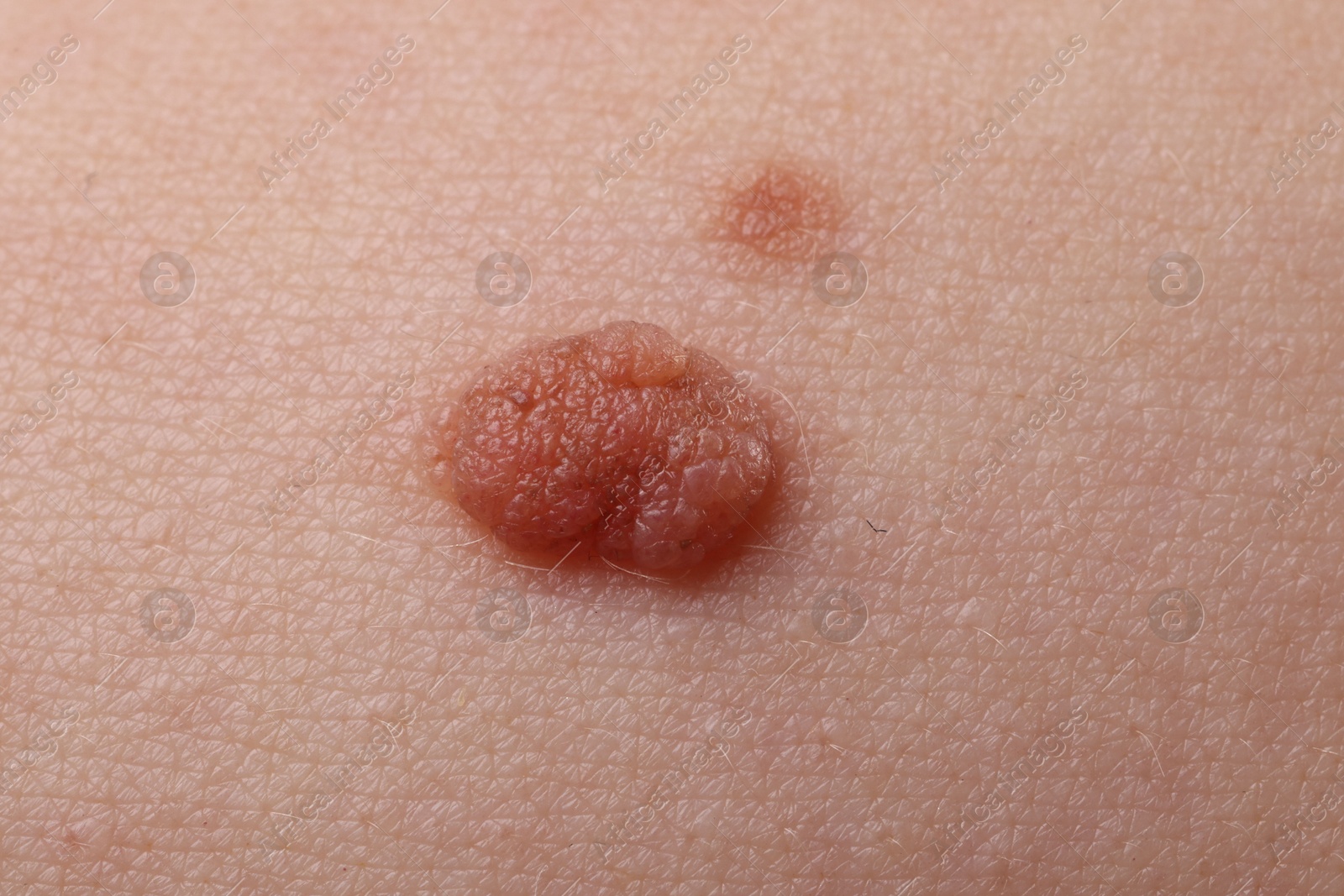 Photo of Woman with moles on her body, closeup