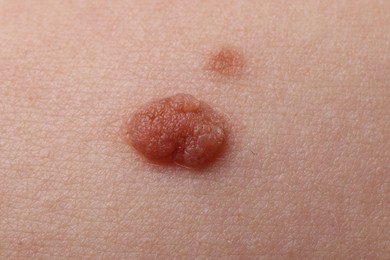 Photo of Woman with moles on her body, closeup
