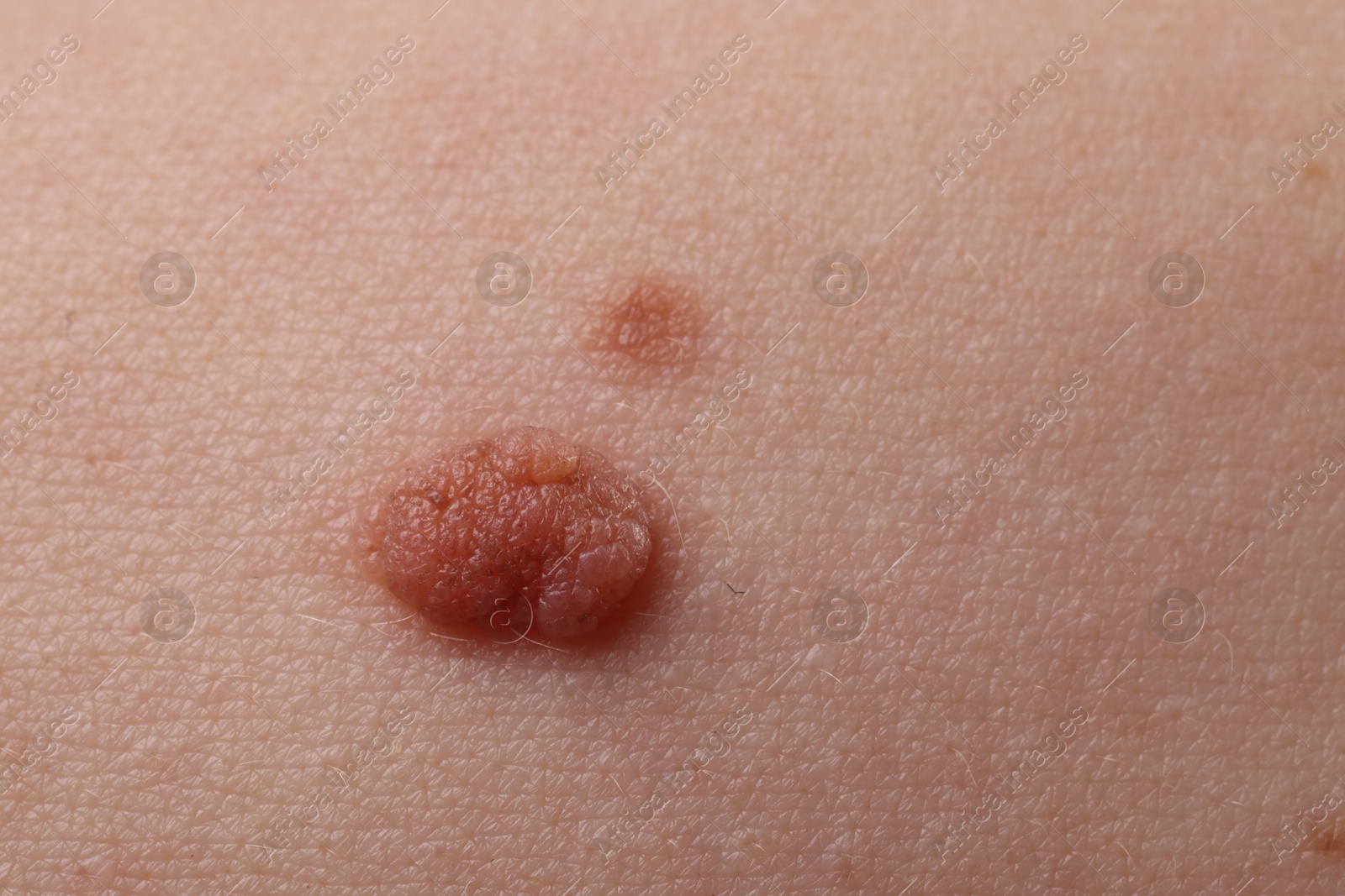 Photo of Woman with moles on her body, closeup