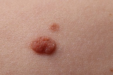 Photo of Woman with moles on her body, closeup