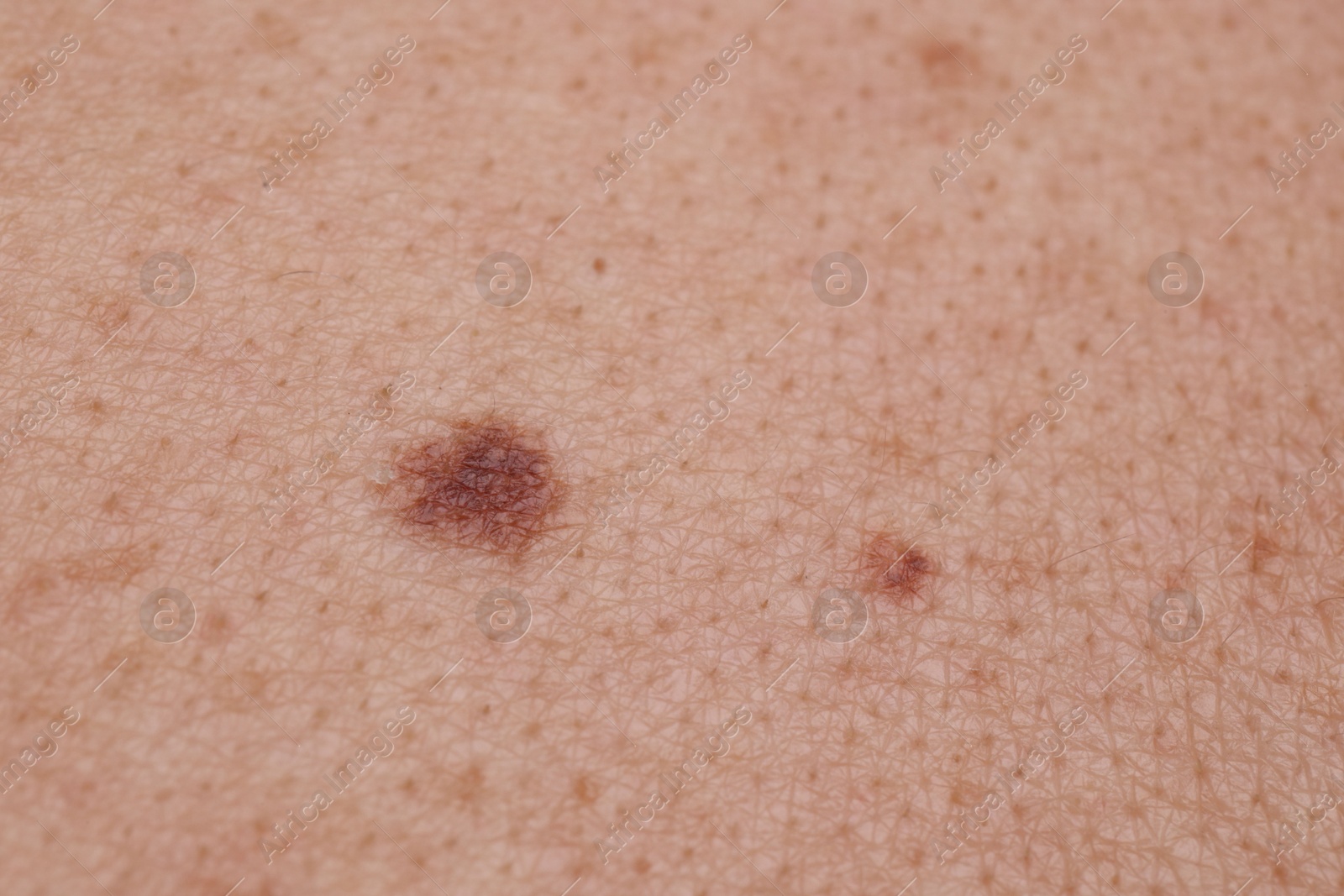 Photo of Woman with moles on her body, closeup
