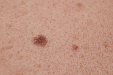 Photo of Woman with moles on her body, closeup