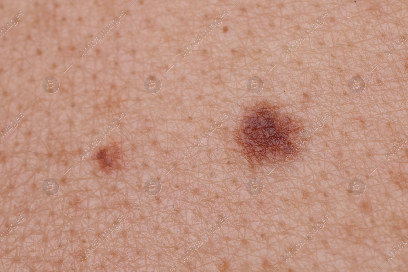 Woman with moles on her body, closeup Photo of Woman with moles on her body, closeup