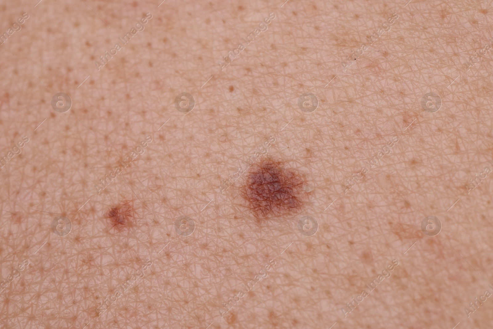 Photo of Woman with moles on her body, closeup