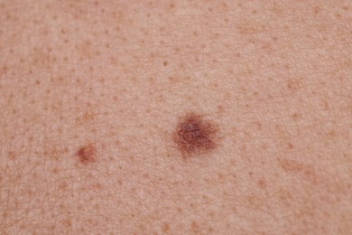 Photo of Woman with moles on her body, closeup