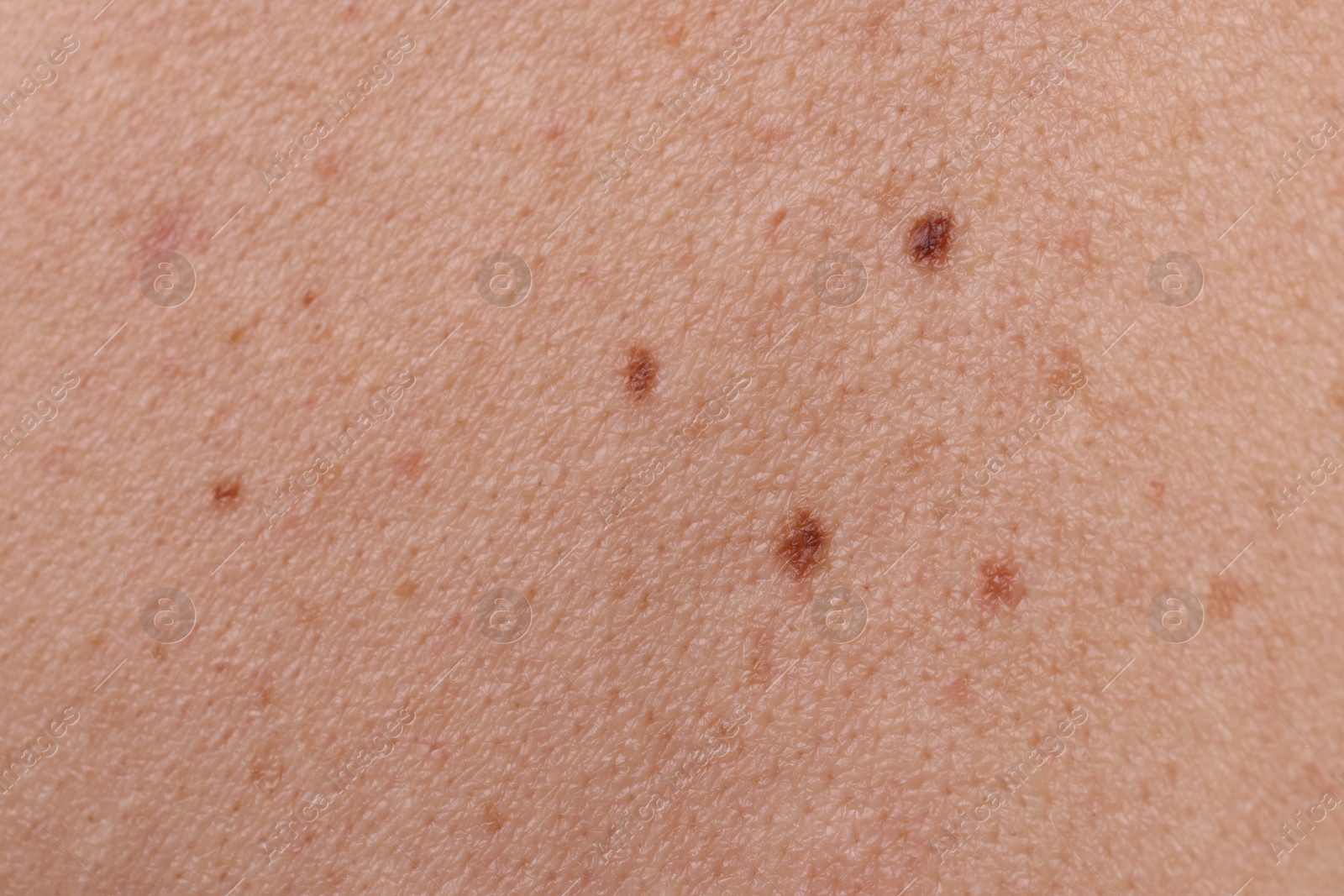 Woman with moles on her body, closeup Photo of Woman with moles on her body, closeup
