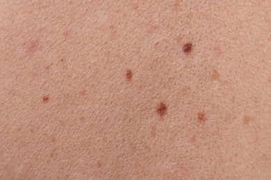 Photo of Woman with moles on her body, closeup