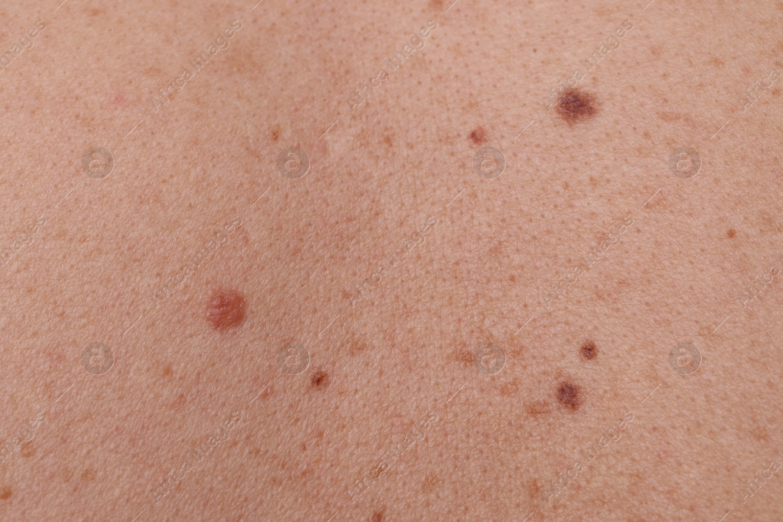 Woman with moles on her body, closeup Photo of Woman with moles on her body, closeup
