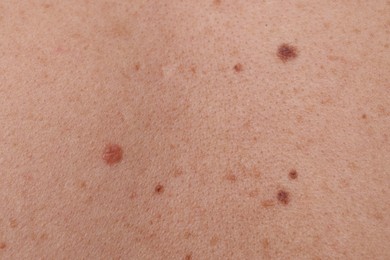 Photo of Woman with moles on her body, closeup