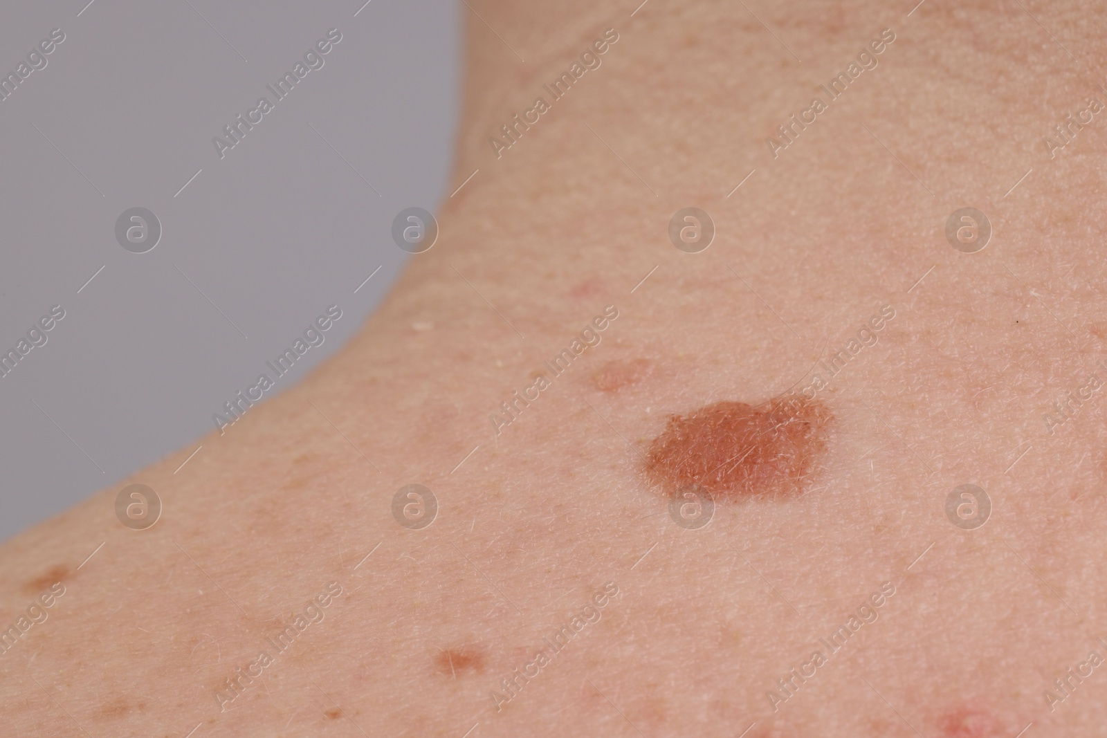 Woman with moles on her body against light background, closeup Photo of Woman with moles on her body against light background, closeup