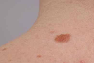 Photo of Woman with moles on her body against light background, closeup