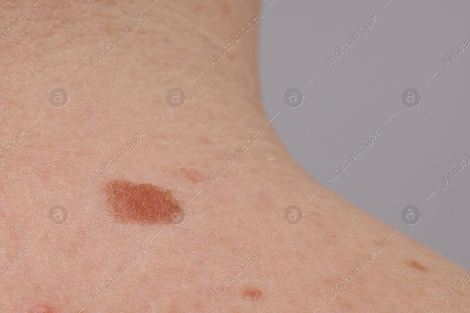 Woman with moles on her body against light background, closeup Photo of Woman with moles on her body against light background, closeup
