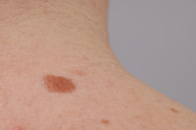 Photo of Woman with moles on her body against light background, closeup