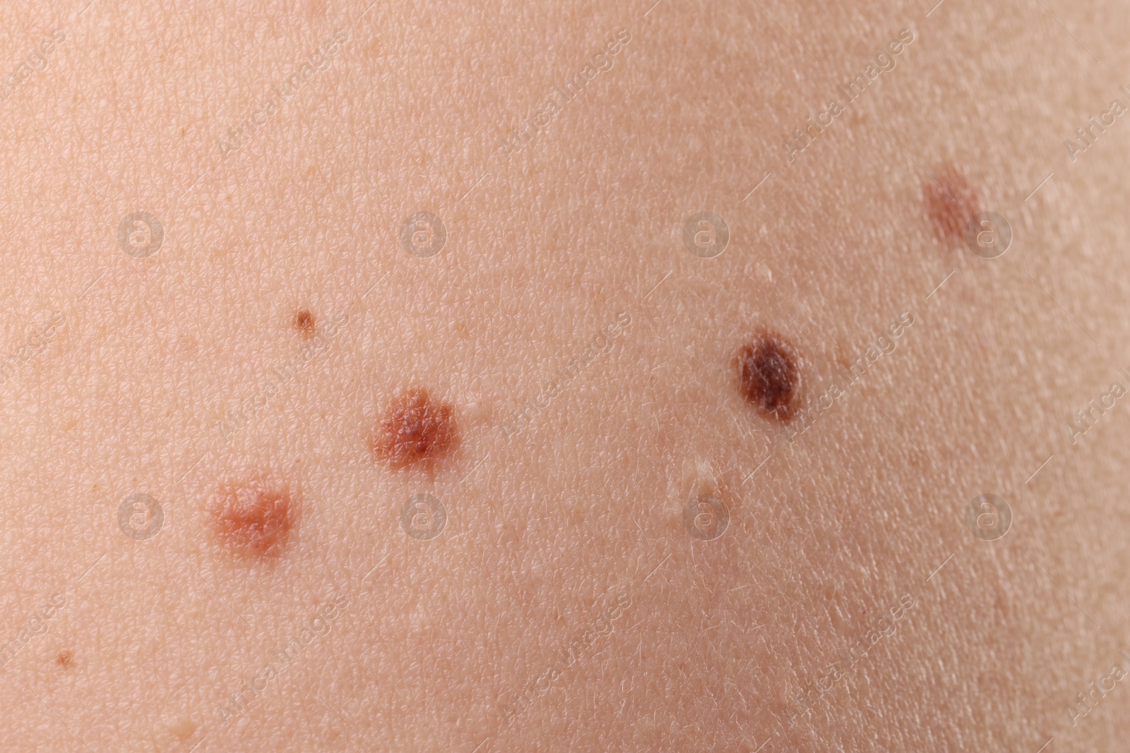 Woman with moles on her body, closeup Photo of Woman with moles on her body, closeup